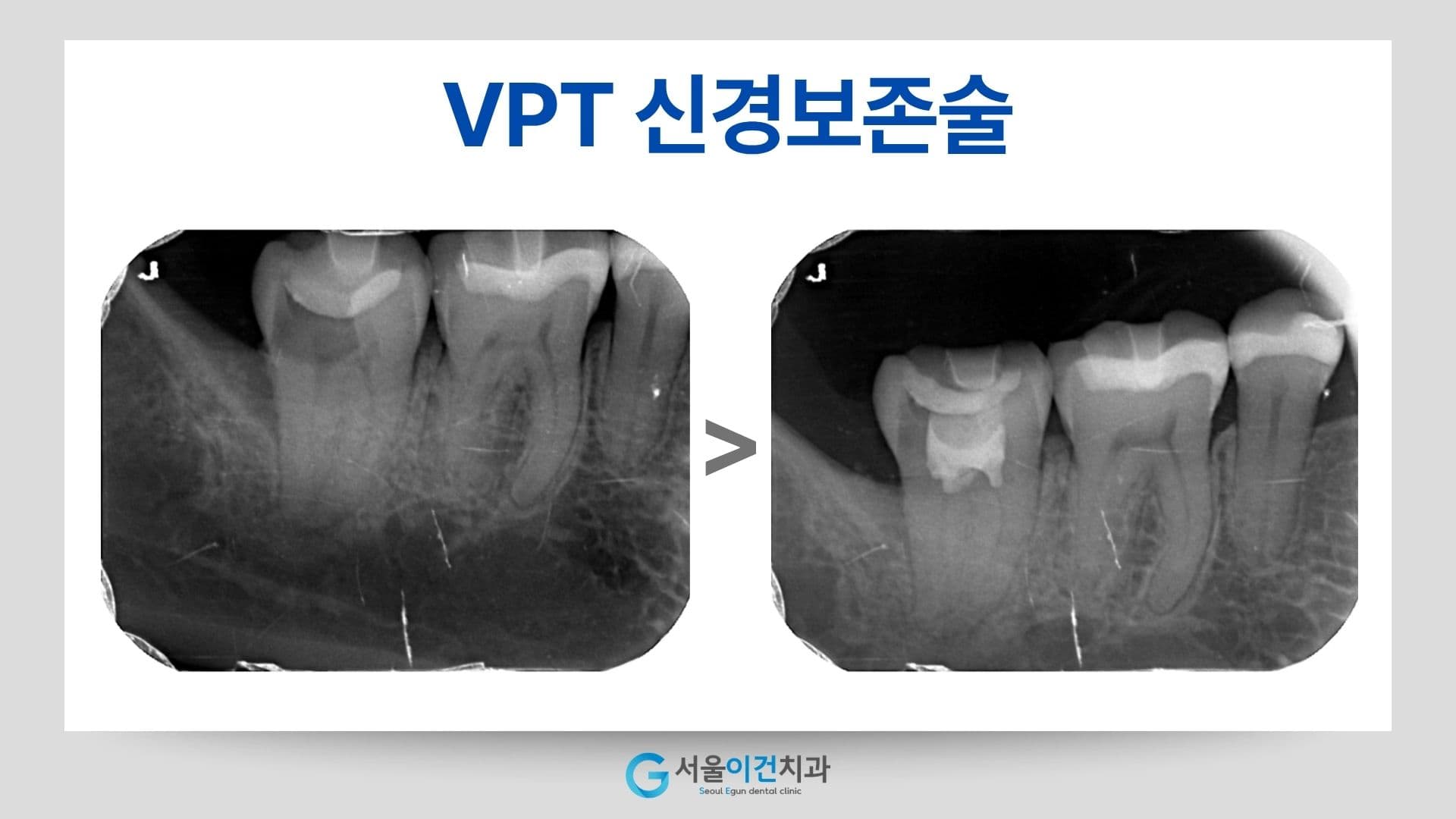 VPT 신경보존술