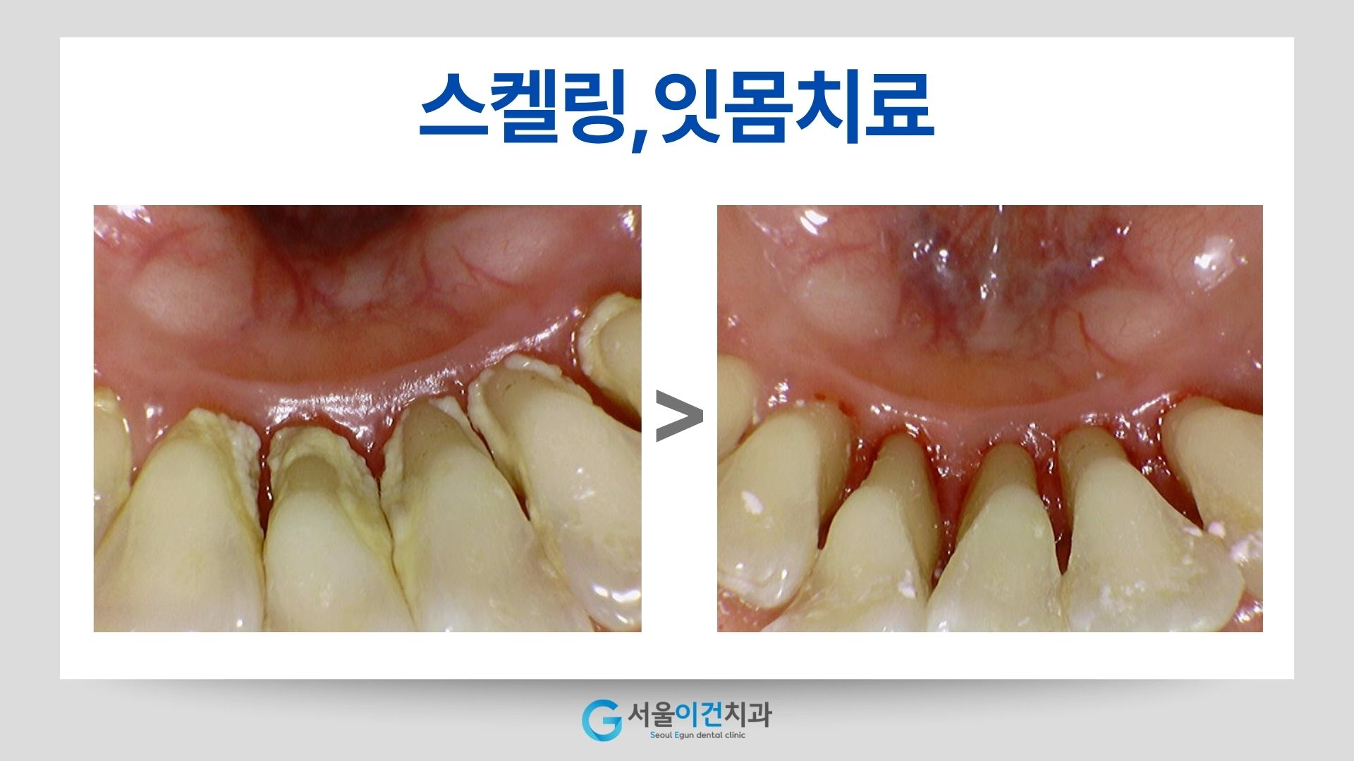 스케일링 전후 아래 앞니 안쪽 치석 제거 비교