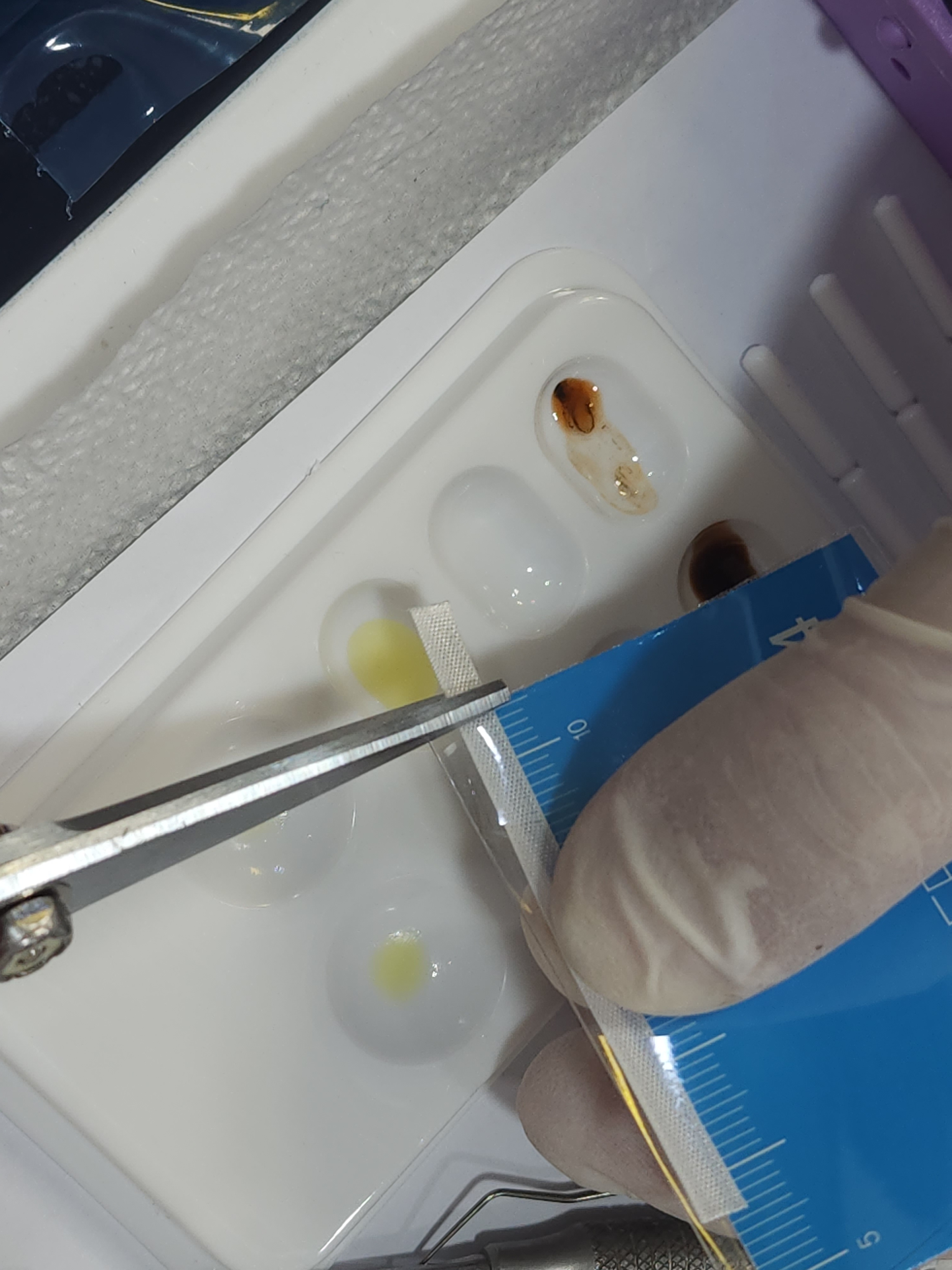 Fiber splint 섬유보강재 적용 — 얇아진 치아벽 사이를 연결하여 힘 분산
